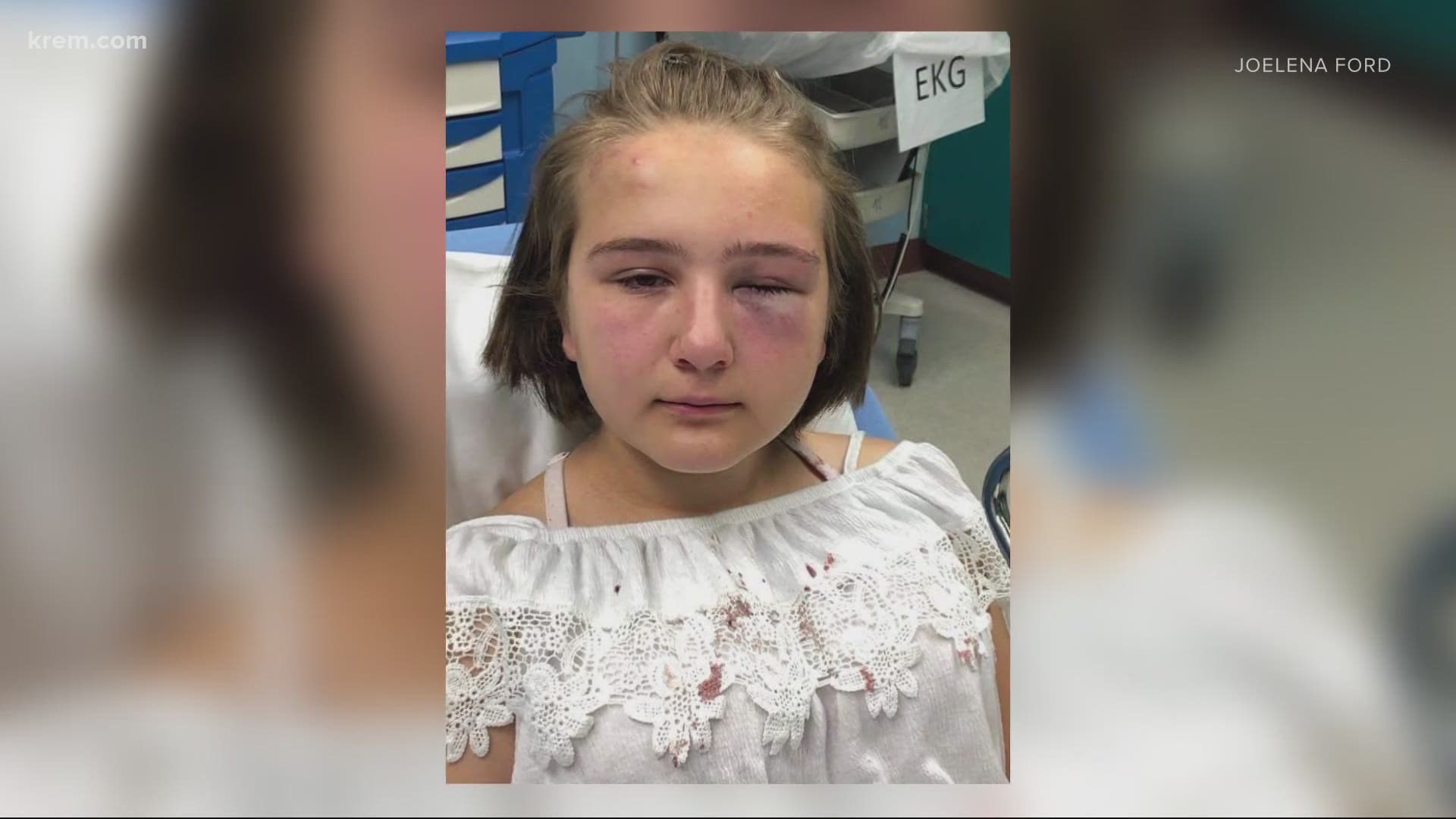 A viral Facebook post shows the victim, a teenage girl, with a swollen eye and bruises on her cheeks.