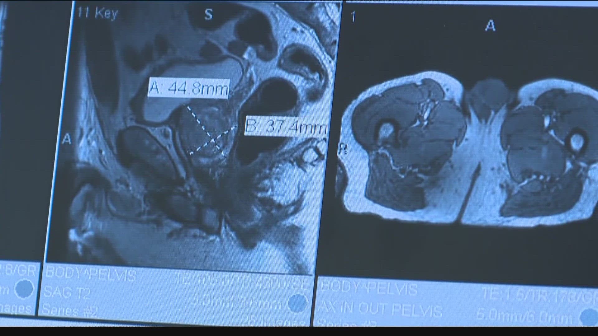 Idaho2Fly's Steve Drabek is in the KTVB studio to discuss the signs and symptoms of the disease, and what the organization does for Idaho men coping with a diagnosis