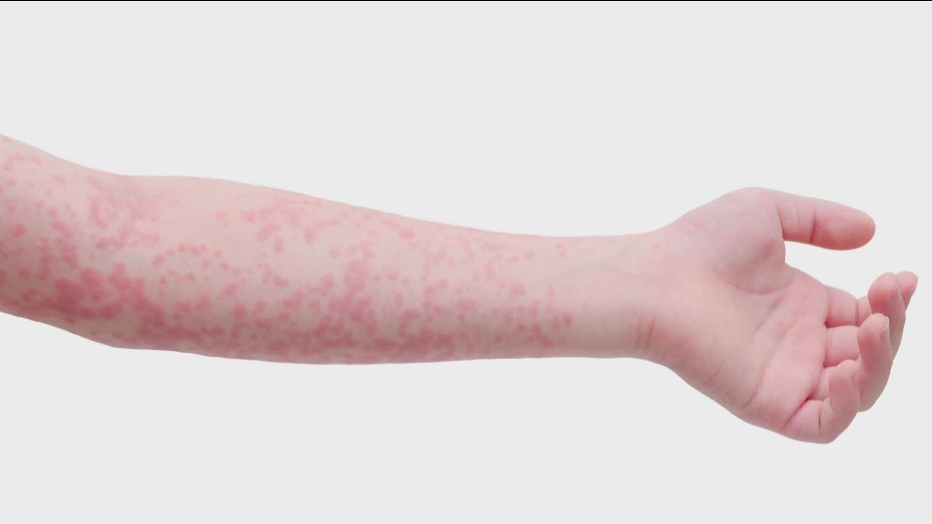 The visitor spent time at Burley establishments during their infectious period. Anyone exposed to measles at these locations could develop symptoms until June 14.