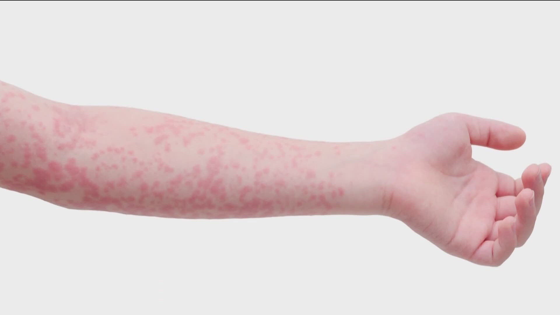 Health officials said the confirmed infection was found in an unvaccinated child in Bonneville County. The case is the first in the region in more than 30 years. 
