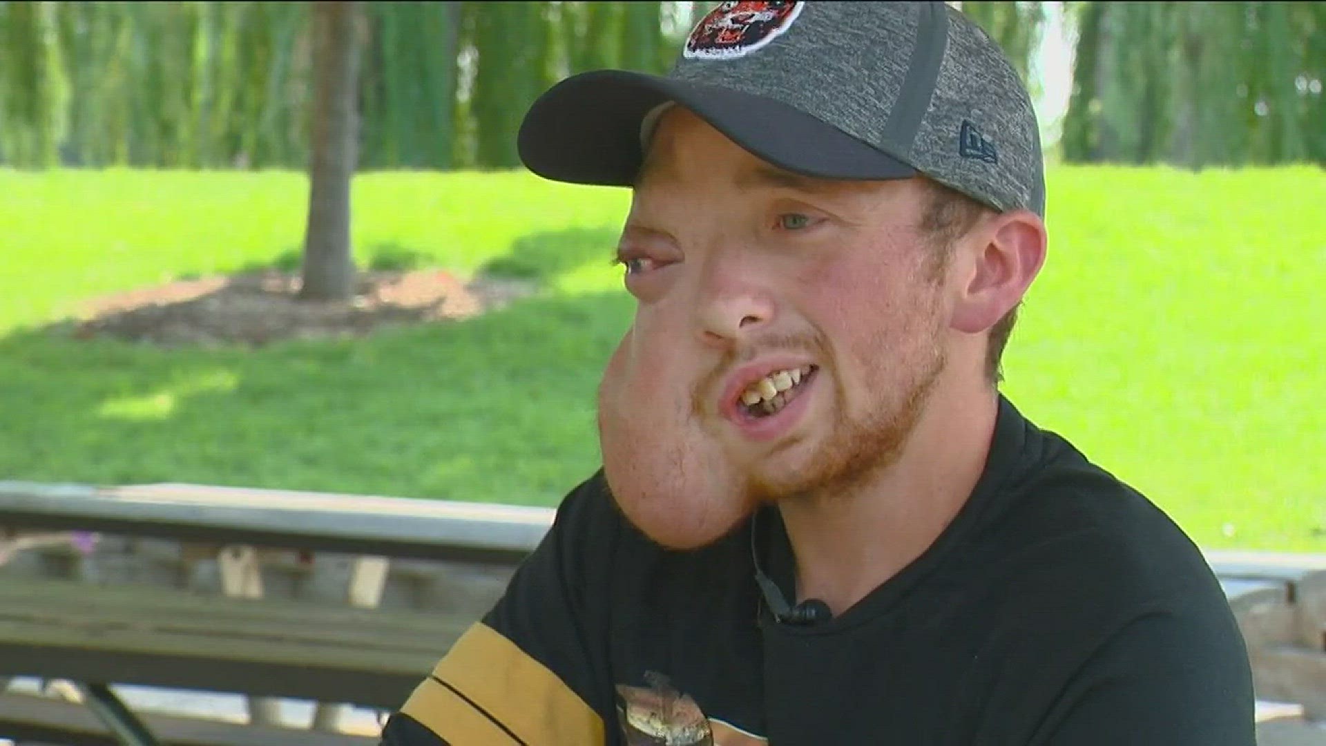 Lucas McCulley has been living with a tumor growing on his face.