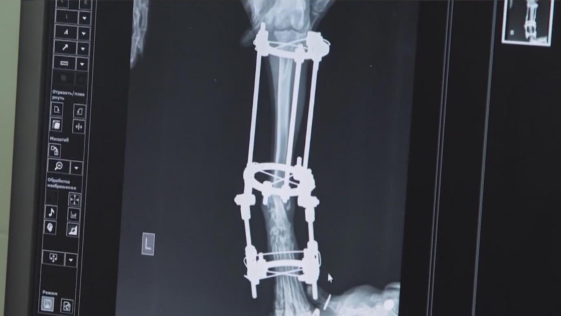 If fractures don't heal properly, it can lead to long-term pain