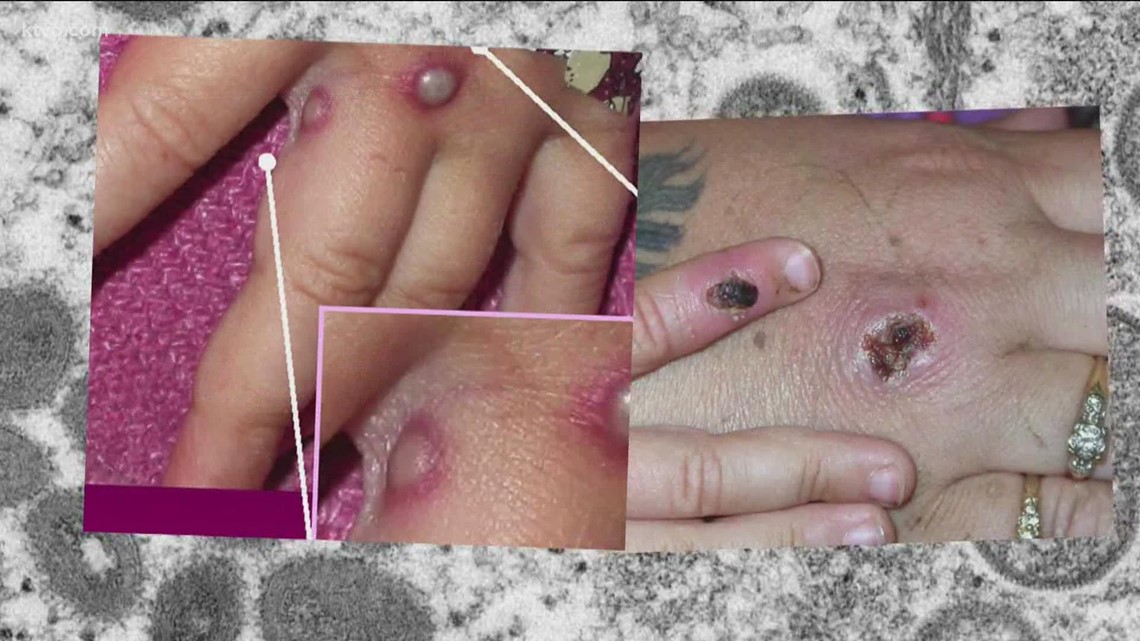 Probable Monkeypox cases in two Utah residents