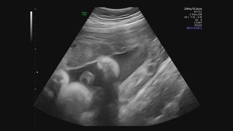 House State Affairs introduces a bill to clarify Idaho abortion law