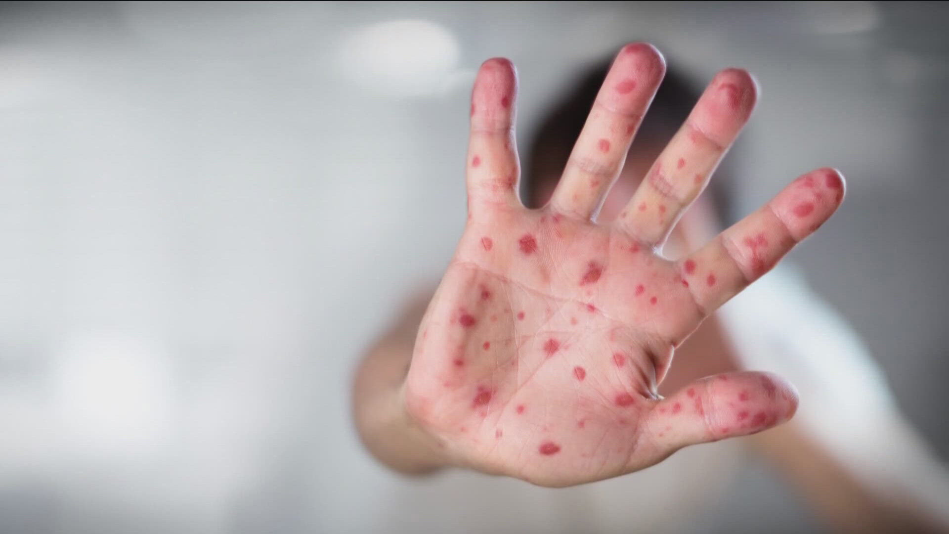 The health district says the confirmed infection was found in an unvaccinated child in Kootenai County. The case is the first in the region in more than 30 years. 